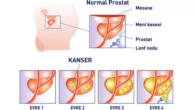 prostat kanseri evreleri